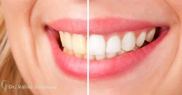  زردی دندان‌ها نشانه چیست؟