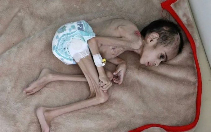 وضعیت دردناک یک کودک اهل غزه پس از تحمل گرسنگی شدید+عکس