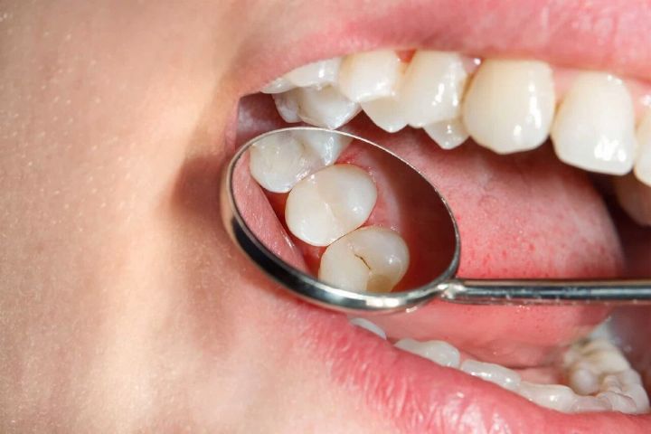چگونه پوسیدگی‌های دندان را کاهش دهیم؟