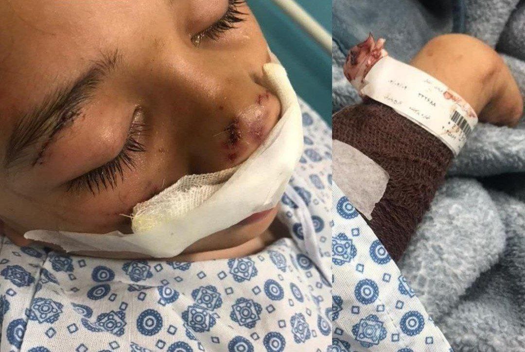 حمله سگ ولگرد به پسربچه 12 ساله + عکس