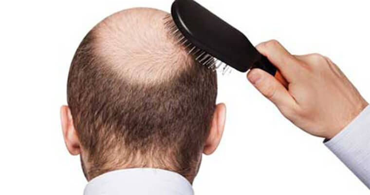 درمان سریع ریزش مو و کچلی با این راهکار ساده
