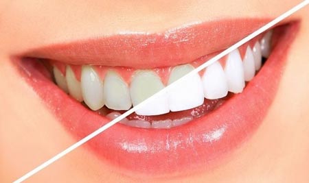  ۱۰ روش برای سفید کردن طبیعی دندان‌ها