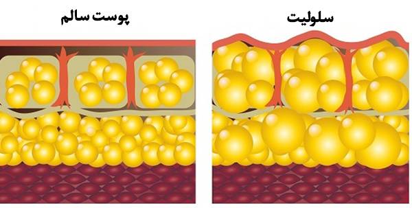 ۱۰ گام ساده برای رهایی از عارضه سلولیت!