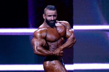 چهره هادی چوپان بعد از کاشت مو در ترکیه+ تصاویر
