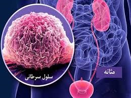 کلید موفقیت در درمان سرطان مثانه چیست؟
