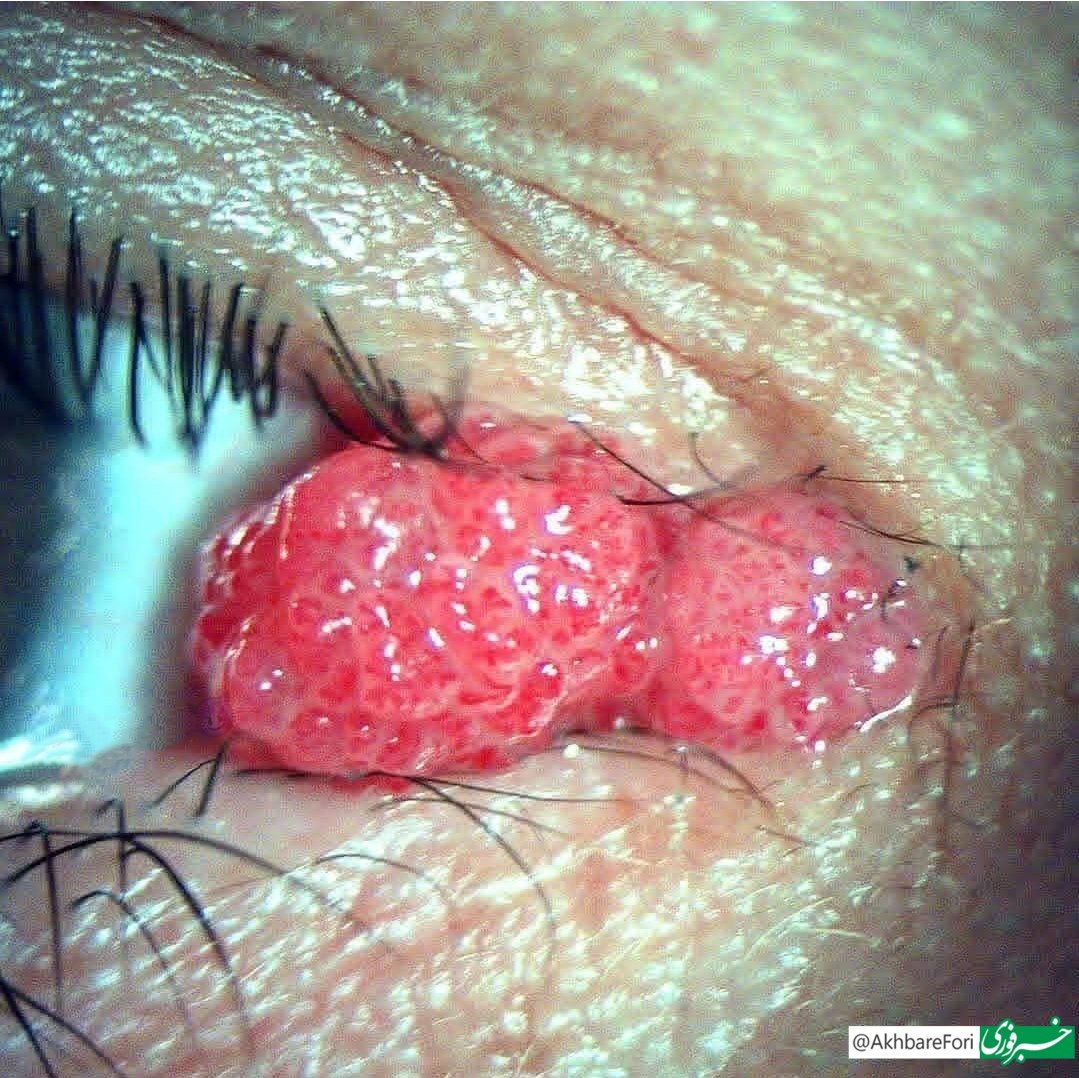تصویری ترسناک از چشم مبتلا به ویروس HPV!+عکس