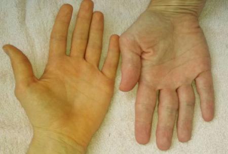 چگونه بفهمیم نارسایی کبد داریم؟/ دلیل زرد شدن سفیدی چشم 