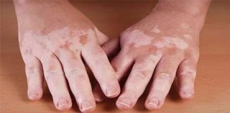 چطور از تشدید بیماری پیسی جلوگیری کنیم؟