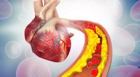 از کلسترول و تری گلیسرید بالا رنج می‌برید؟ این راهکارها برای شماست