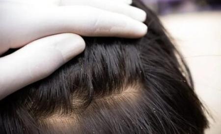 برای خلاصی کودکتان از شپش این کار را کنید