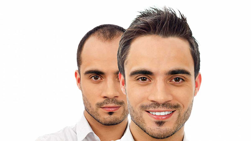 کاشت مو HRT چیست؟