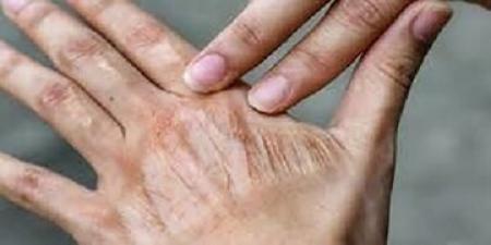 برای رفع خشکی پوست این اقدام ساده را انجام دهید