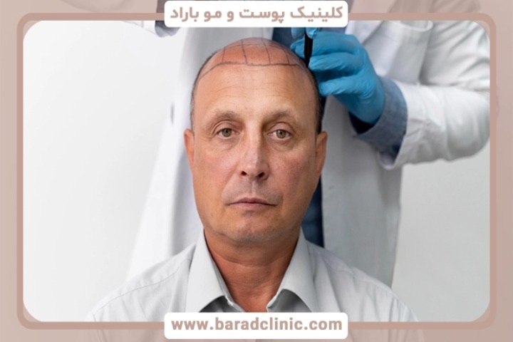 کاشت مو و رازهای موهای پرپشت: از طب سنتی تا جدیدترین روش‌ها