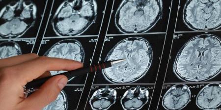 کلید بازگشت از سکته مغزی در این ساعات اول است