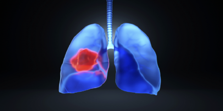 عامل کلیدی توسعه سرطان ریه کشف شد