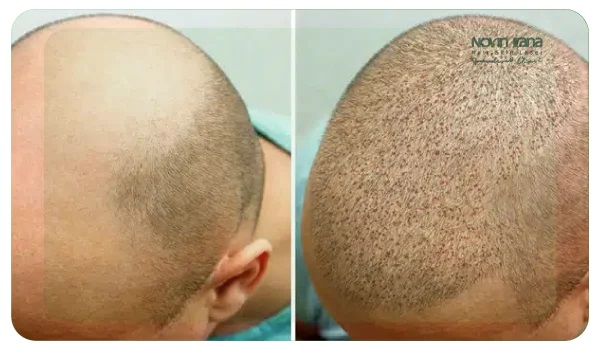 آگهی/ کاشت مو در یک روز: از طاسی تا تراکم طبیعی