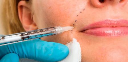 عارضه خطرناکی که بعد از تزریق فیلر صورت سراغ تان می آید
