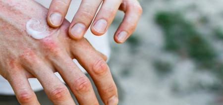 چطور خشکی پوست را در سرمای هوا درمان کنیم؟