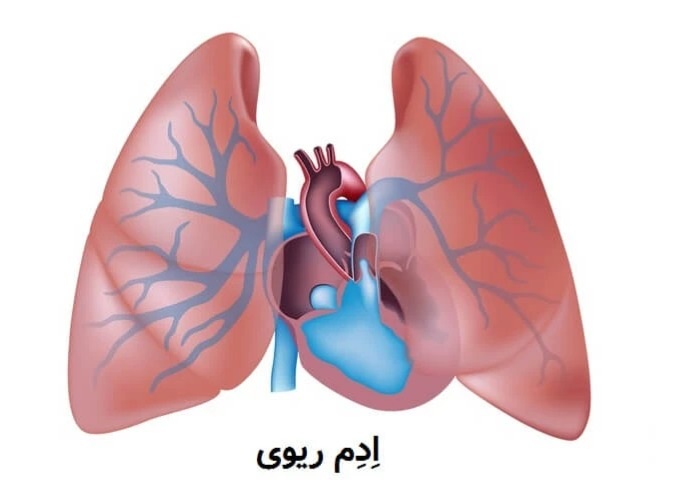 آگهی/ درمان آب آوردن ریه در سالمندان: راهنمای جامع و تخصصی