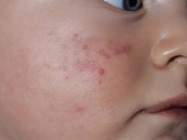 این برجستگی های پوستی نشان از یک  بیماری التهابی است ! 