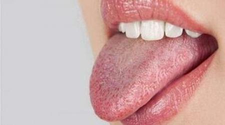 علت سفیدی روی زبان و بوی بد دهان چیست؟