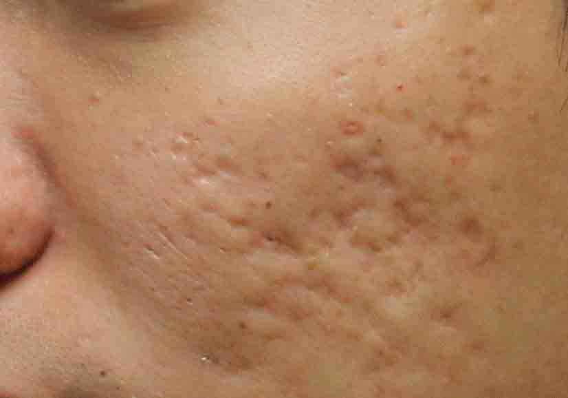 بیماری پنهان پشت جوش‌های صورت
