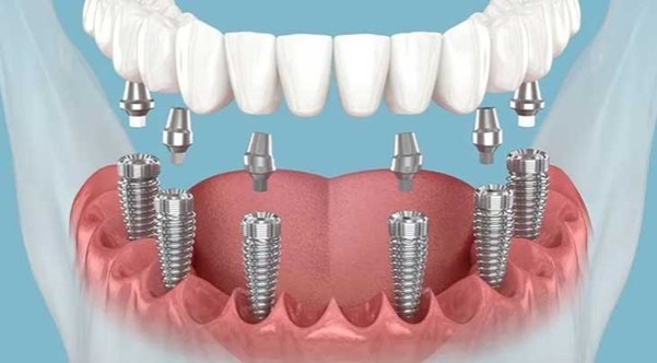 آگهی/ آیا برای هر دندان یک ایمپلنت لازم است؟