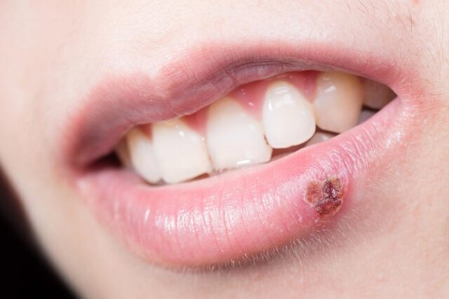 چرا وقتی تبخال می‌زنیم نباید دچار استرس شویم؟