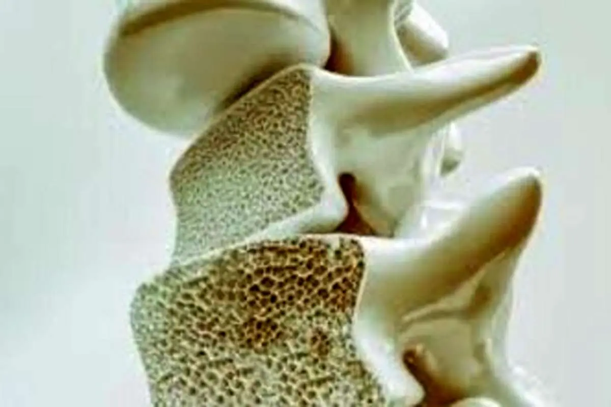این بیماران در معرض پوکی استخوان هستند