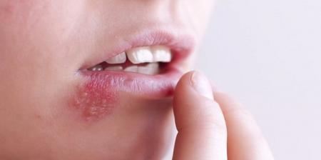 ابتلا به تبخال لب در کودکی باعث این بیماری خطرناک در پیری می شود!