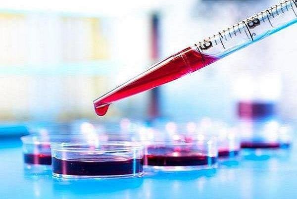 تشخیص کبدچرب با یک آزمایش خون ساده
