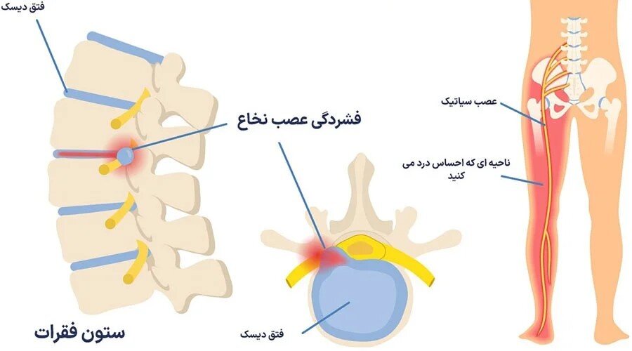 تفاوت دیسک کمر و عصب سیاتیک چیست؟