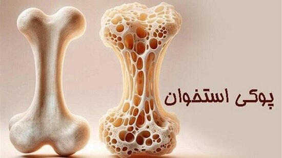 پوکی استخوان: سکوتِ خاموش استخوان‌ها؛ چگونه و چه زمانی باید غربالگری کنیم؟
