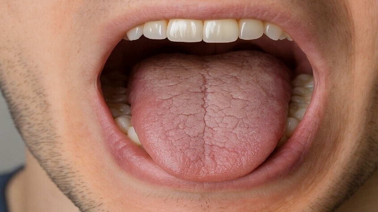 علت اصلی خشکی دهان چیست؟