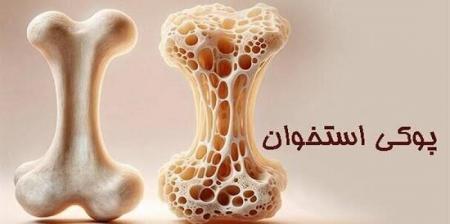 هشدار پزشکان؛ پوکی استخوان تا زمان شکستگی بی‌علامت است