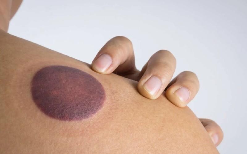 حجامت چه معایبی دارد؟