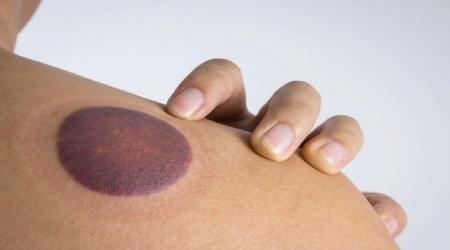 حجامت چه معایبی دارد؟