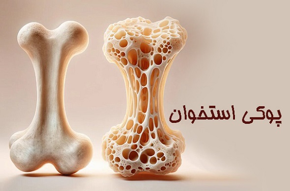 هشدار فوق‌تخصص ارتوپدی درباره فراگیر شدن پوکی استخوان در کشور
