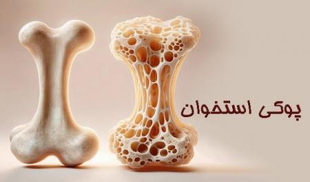 هشدار فوق‌تخصص ارتوپدی درباره فراگیر شدن پوکی استخوان در کشور
