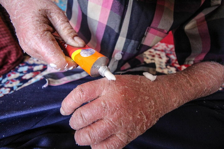 خانه ای‌بی اعلام کرد: غرامت ۶۳۲ بیمار پروانه‌ای واریز شد