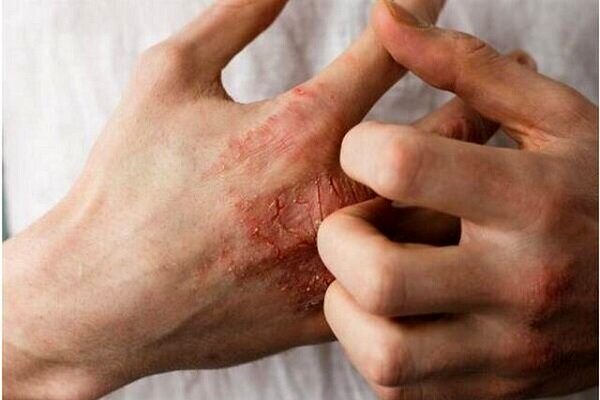 طاعون چه علائمی دارد و چطور منتقل می‌شود؟