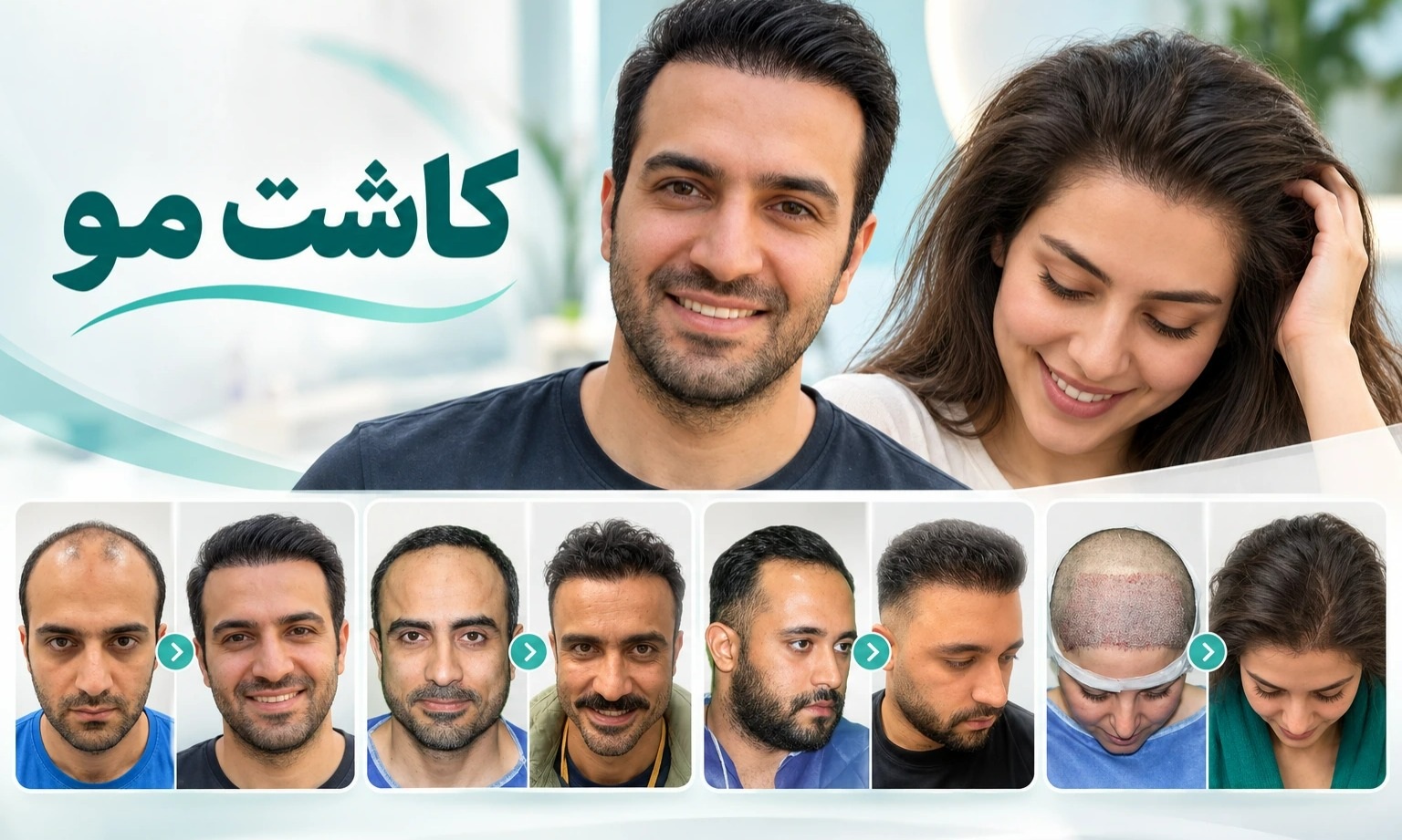 بهترین روش کاشت مو در سال ۱۴۰۵؛ مقایسه روش‌ها برای رسیدن به نتیجه طبیعی