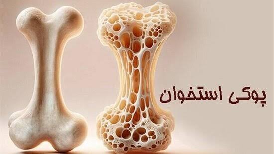 پیشگیری از پوکی استخوان از تشخیص به‌موقع آغاز می‌شود+ اینفوگرافی