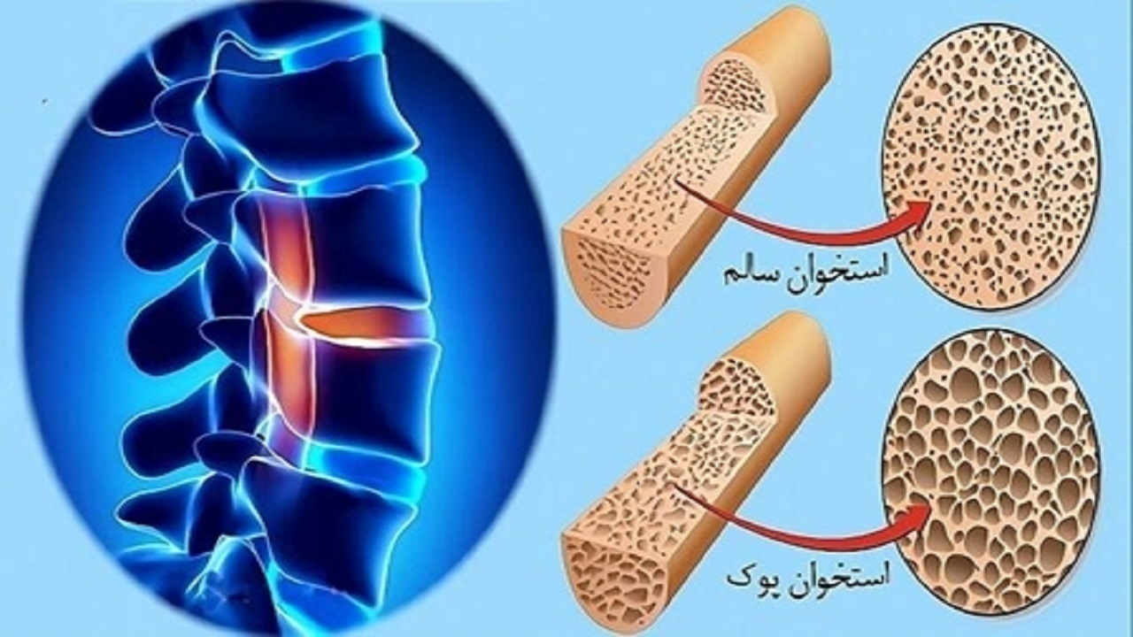 دو مقصر اصلی ابتلا به پوکی استخوان را بشناسید