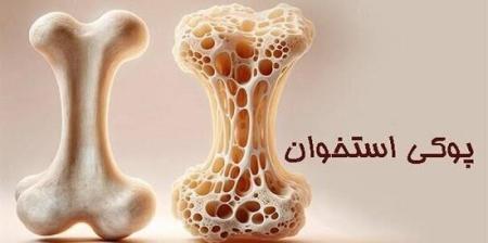 ۵ نشانه پوکی استخوان+ اینفوگرافی