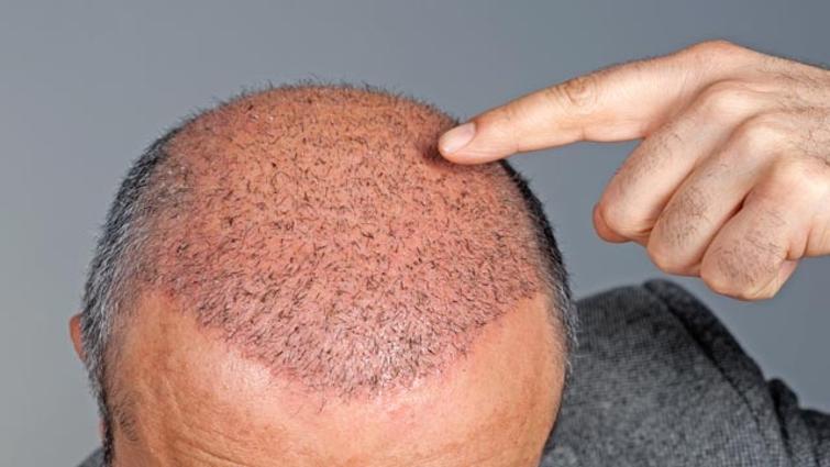 کدام روش کاشت مو مناسب شماست ؟