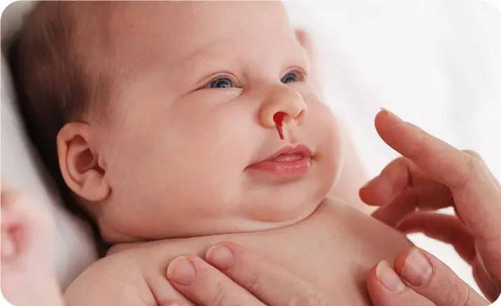 چرا برخی کودکان دچار خونریزی از بینی می شوند؟