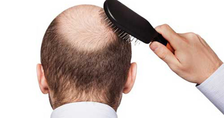 عوارض پیوند مو چیست