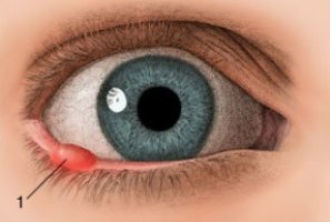 علت بروز گل مژه در چشم چیست؟