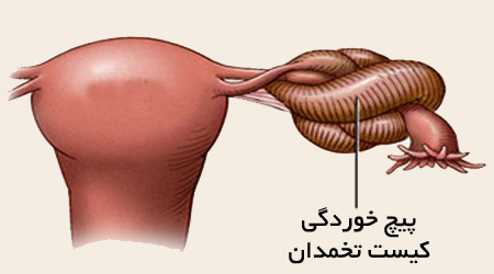وقتی تخمدان پیچ می خورد
